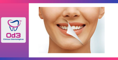 BLANQUEAMIENTO DENTAL LIMA