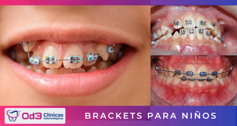 Brackets En Lima 2021 – OD3 Clínicas Odontológicas