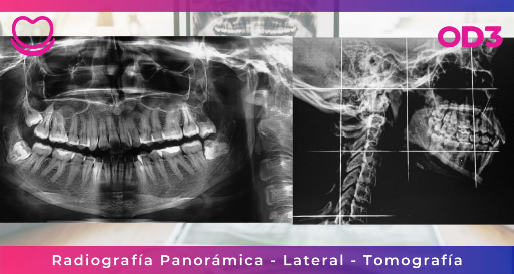 Radiografía Panorámica - Lateral - Tomografía